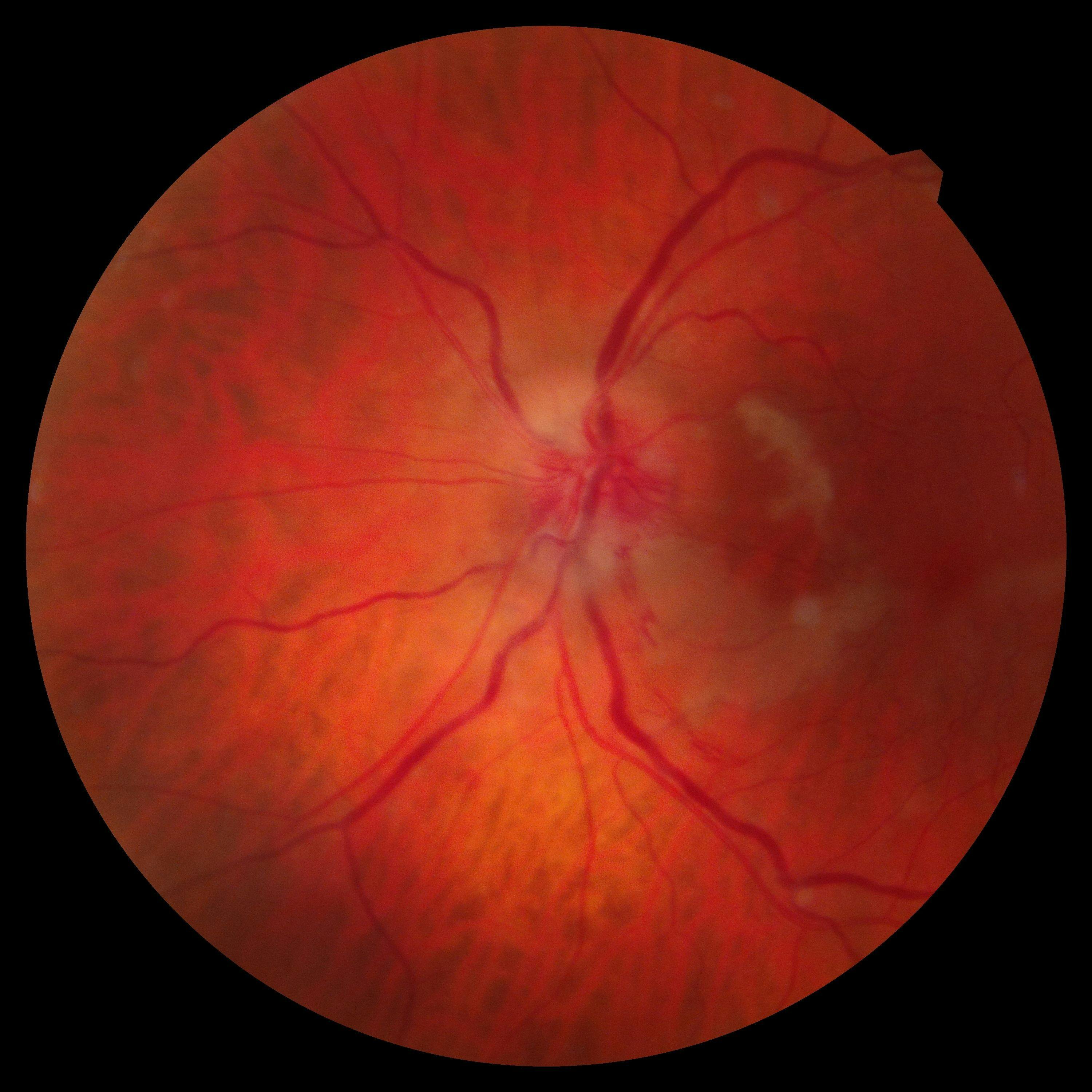 OS fundus 5 day review