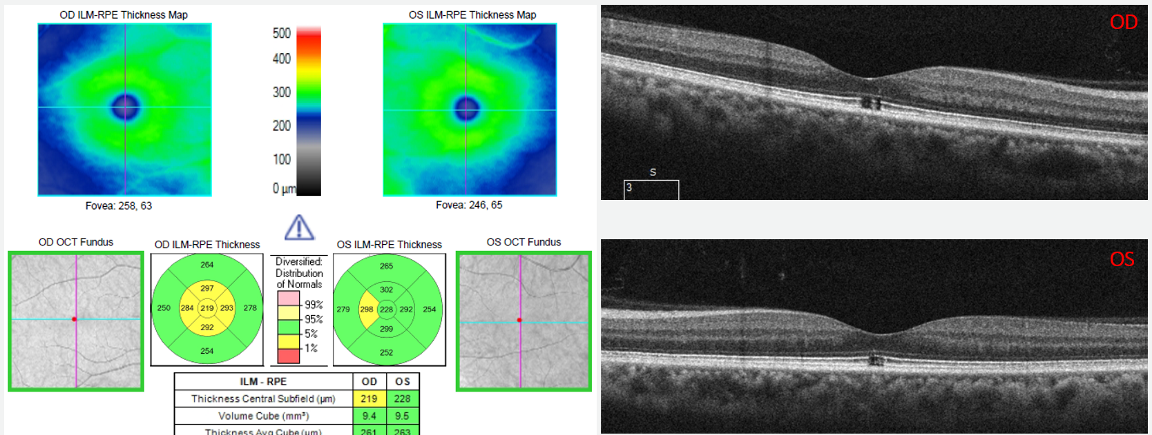 This case highlights the importance of always reviewing the B-scans in relation to the macular thickness maps on the diagnostic report.  The B-scan image clearly shows outer retinal loss without traction