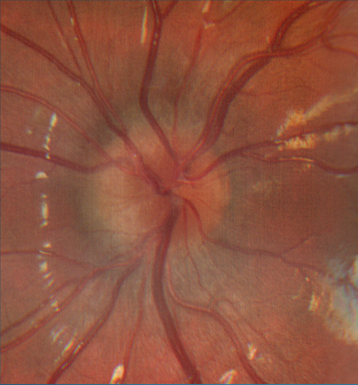 Figure 23 reveals similar presentation for the patient’s left optic nerve as compared to the right eye.