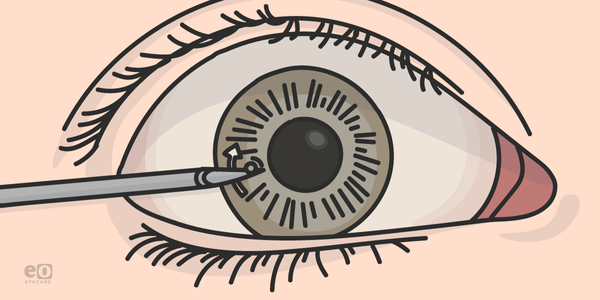 5 Procedures Every Ophthalmology Resident Must Know