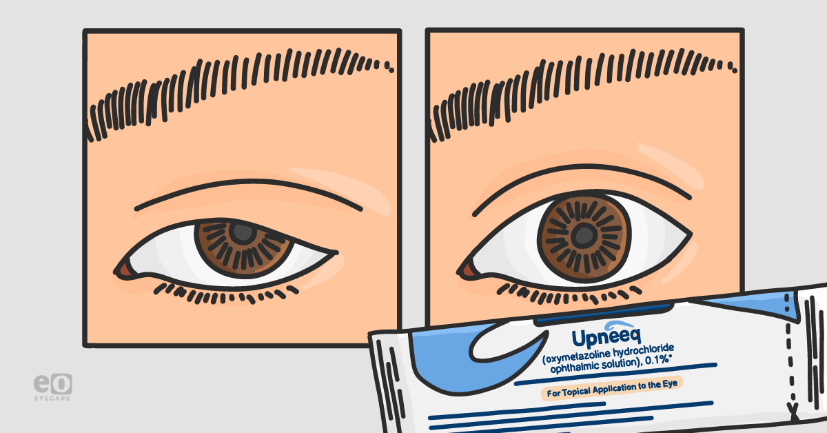 The Ultimate Guide to Upneeq® for Eyelid Ptosis