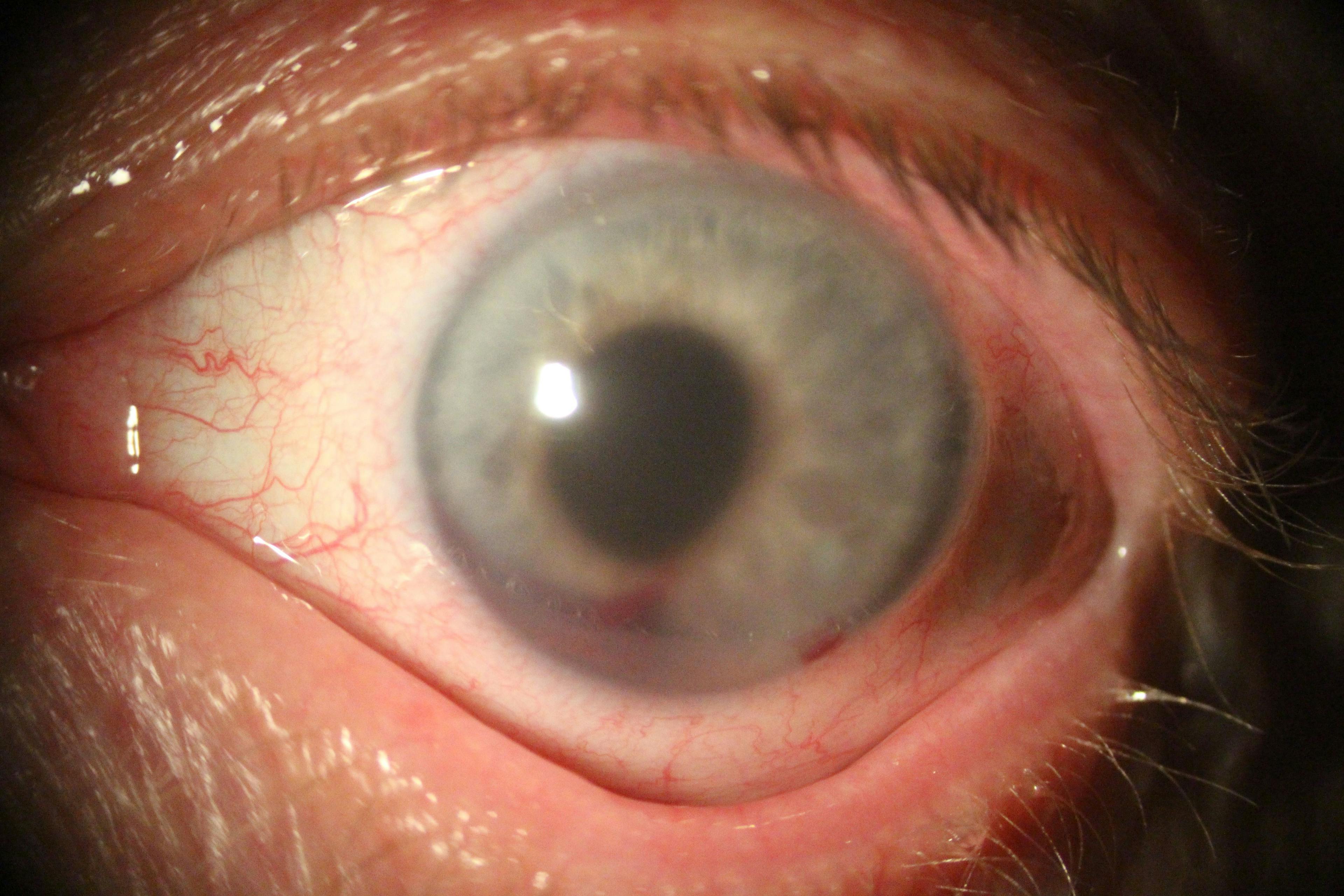 Post-MIGS Microhyphema