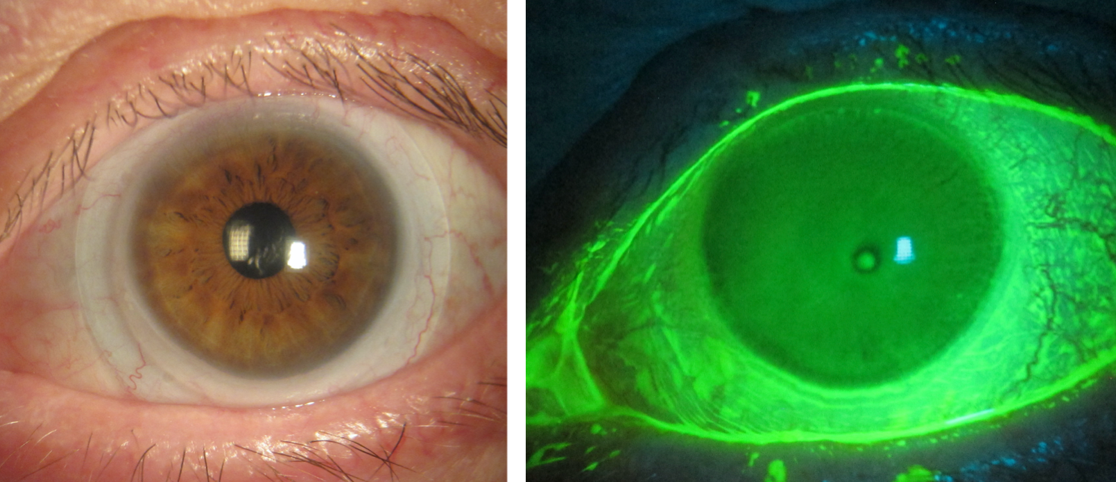 Corneal Surface Improvement with Scleral Lens