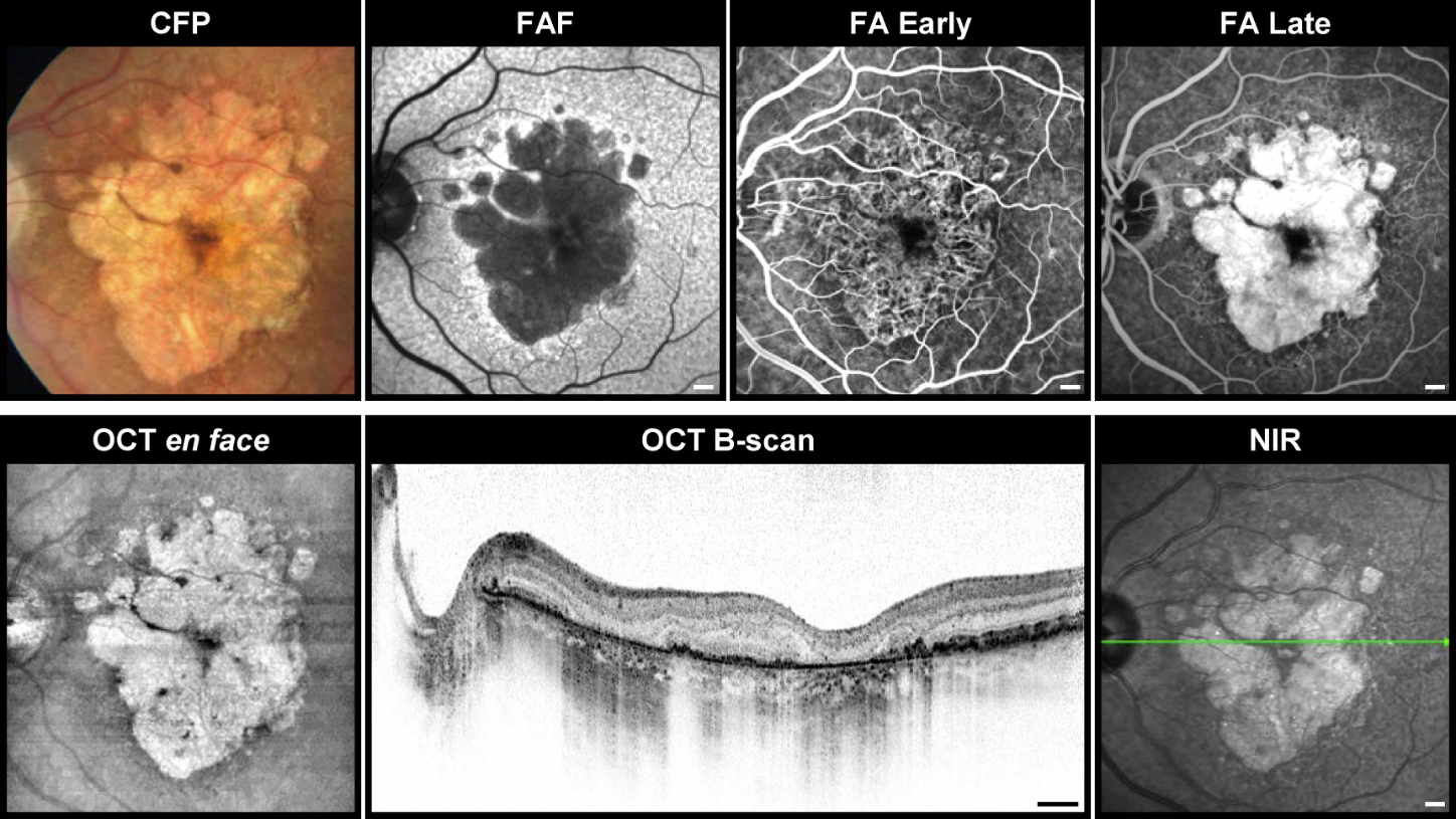 Multimodal Imaging of Geographic Atrophy