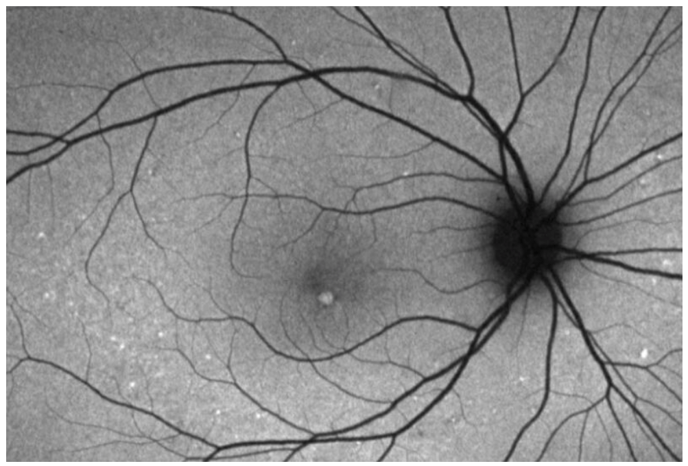 Foveomacular vitelliform retinal pattern dystrophy