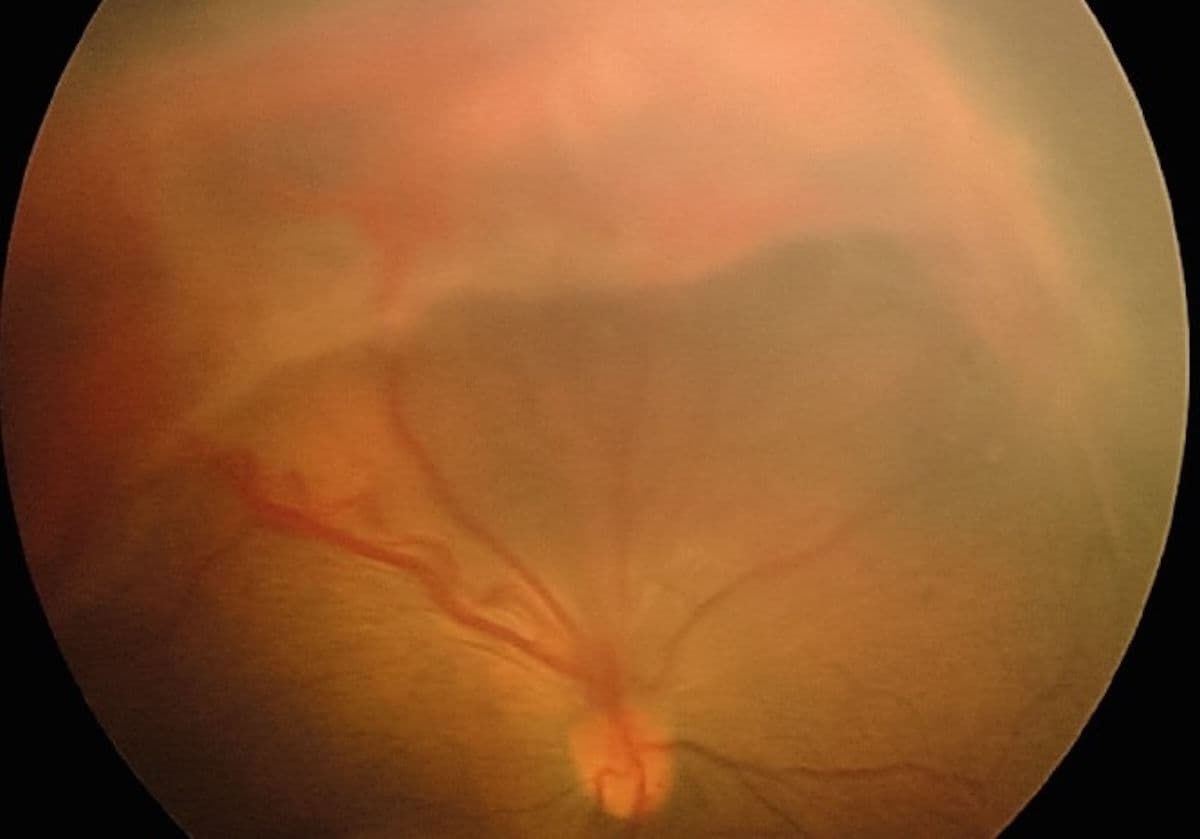 Update on the Diagnosis and Management of Retinopathy of Prematurity