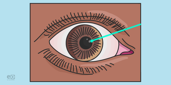 Comparative Guide of Refractive Surgery with Cheat Sheet