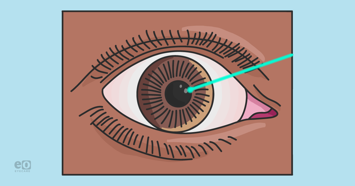 Comparative Guide of Refractive Surgery with Cheat Sheet