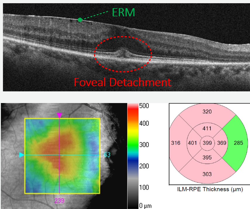 The traction of this progressed ERM has caused the fovea to begin to detach.  Thickening may be seen on both the retinal map and the B-scan image