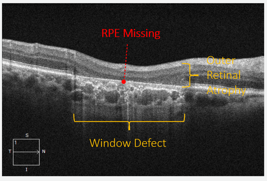 In this view of geographic atrophy note the window defect and increased visibility of choroidal detail due to the missing reflective signal of the RPE