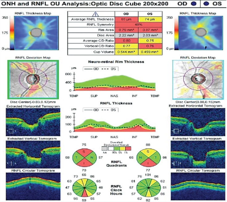 OCT and RNFL analysis glaucoma