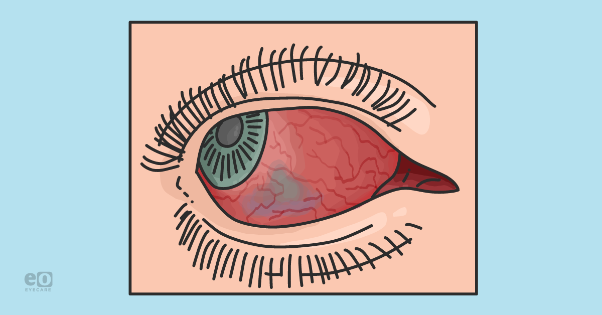 Conjunctivitis, Episcleritis, Scleritis, Oh My! with Differential Diagnosis Cheat Sheet