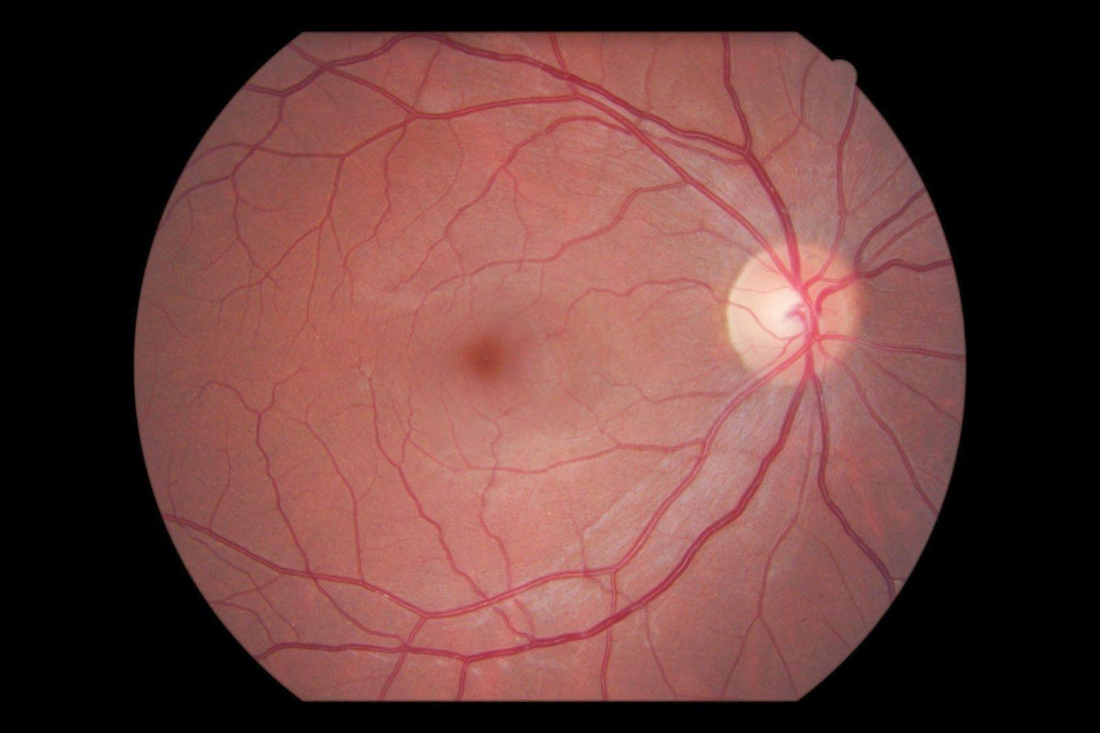 Optic Neuritis Retrobulbar Inflammation