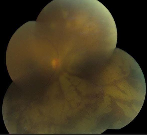 Figure 1: A patient presenting with progressive outer retinal necrosis (PORN) viral retinitis with a known history of acquired immunodeficiency syndrome (AIDS) secondary to human immunodeficiency virus (HIV).