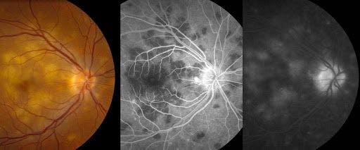Figure 8: Presentation of posterior uveitis secondary to tuberculosis infection with posterior pole plaques. Angiography displays characteristic early hypofluorescence followed by late hyperfluorescence.