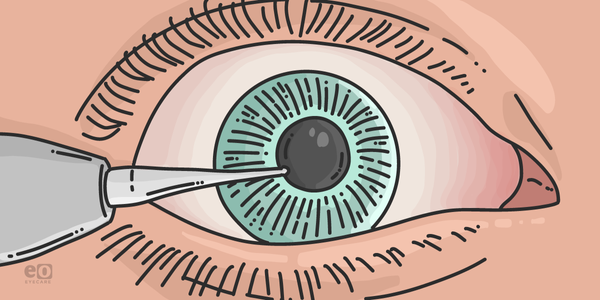 The Ins and Outs of Corneal Foreign Body Removal