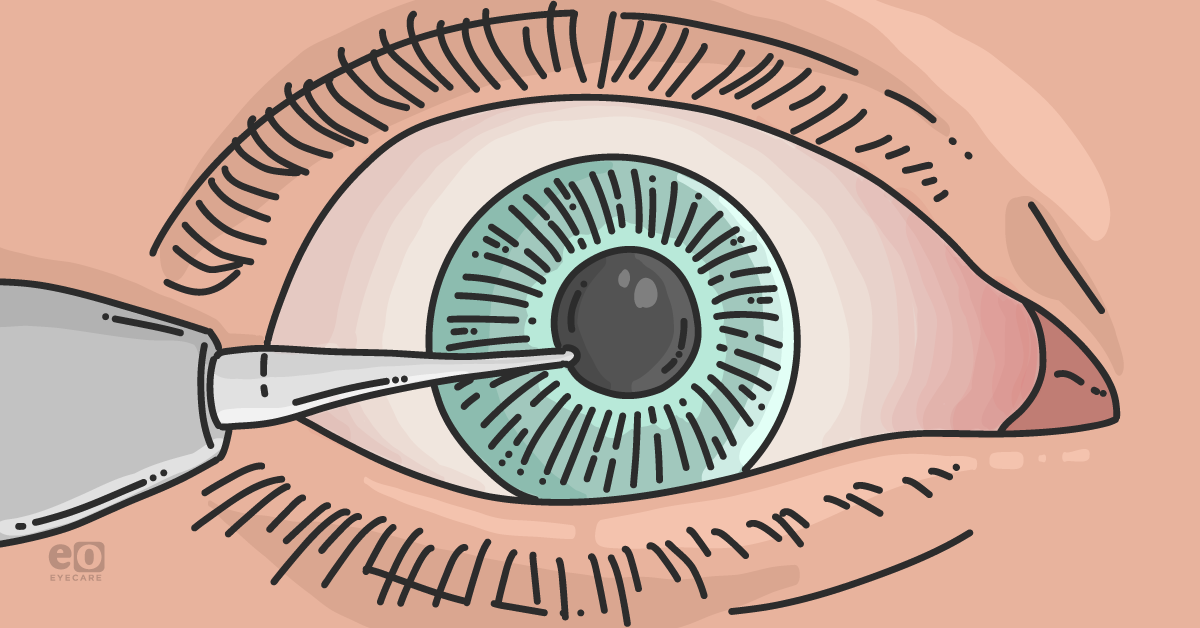 The Ins and Outs of Corneal Foreign Body Removal