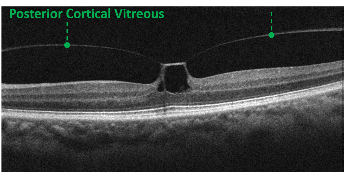 vitreomacular traction
