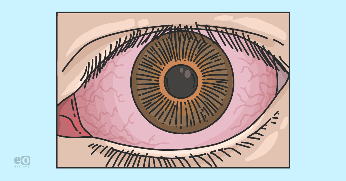 Closeup of an eye that looks red and irritated due to epidemic keratoconjunctivitis (EKC).