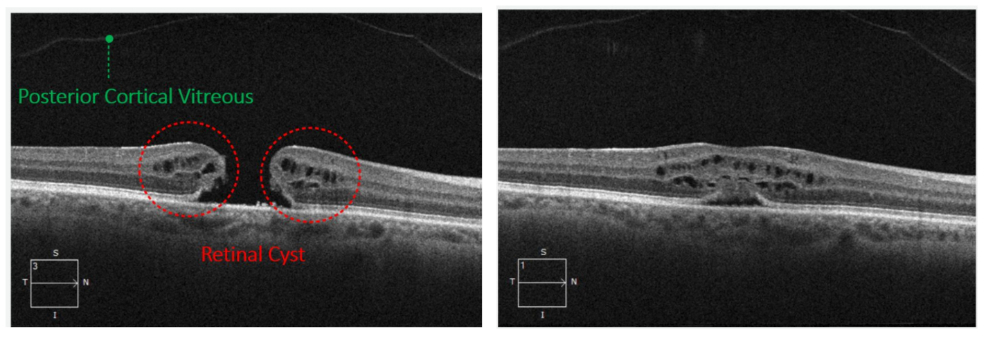 Raster and radial scans provide multiple B-scans allowing a high resolution view of the pathology from several different angles.  In this raster scan a full thickness macular hole can be seen.  The view on the left is through the foveal center while the view on the right is off axis. If only the off axis view is evaluated the patient appears to have solely macular edema.  However when viewed in tandem it becomes apparent this patient has a full thickness macular hole and the off axis scans are simply the peripheral portion of that macular hole. In the image to the left a full thickness macular hole is associated with perifoveal cysts.  The posterior cortical vitreous has completely pulled away releasing the traction and indicating the presence of a PVD