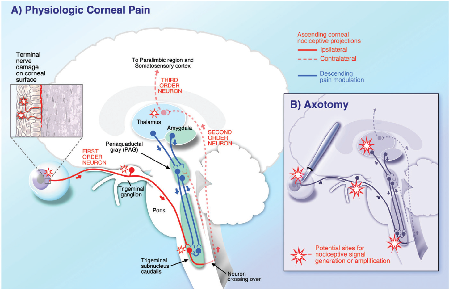 Physiologic Pathway of Corneal Pain