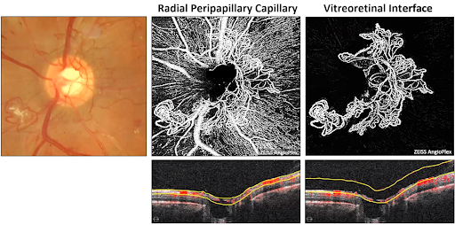 Radial Peripapillary Capillary