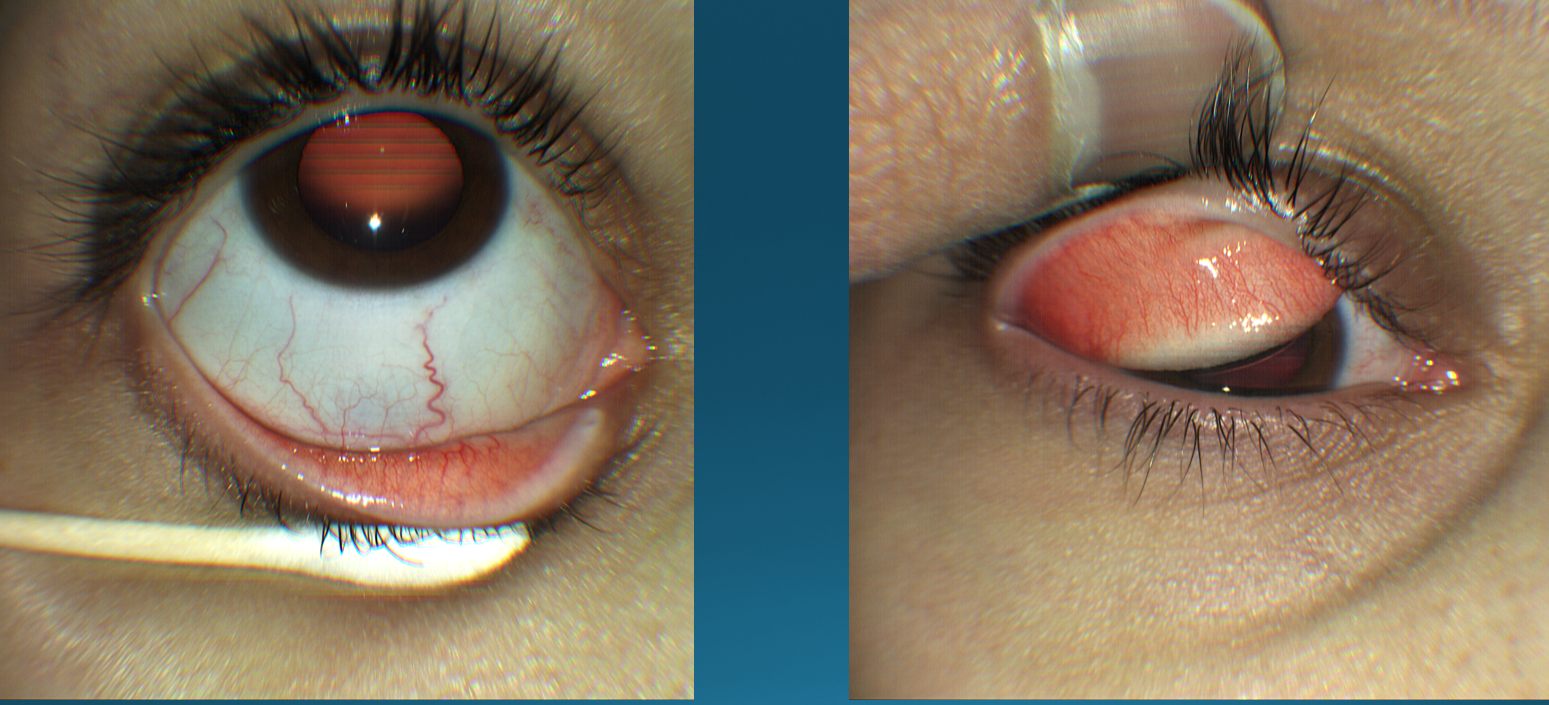 Figure 4: Anterior segment camera of the Zeiss CLARUS 500 imaging a patient with allergic conjunctivitis in its very mild stage.