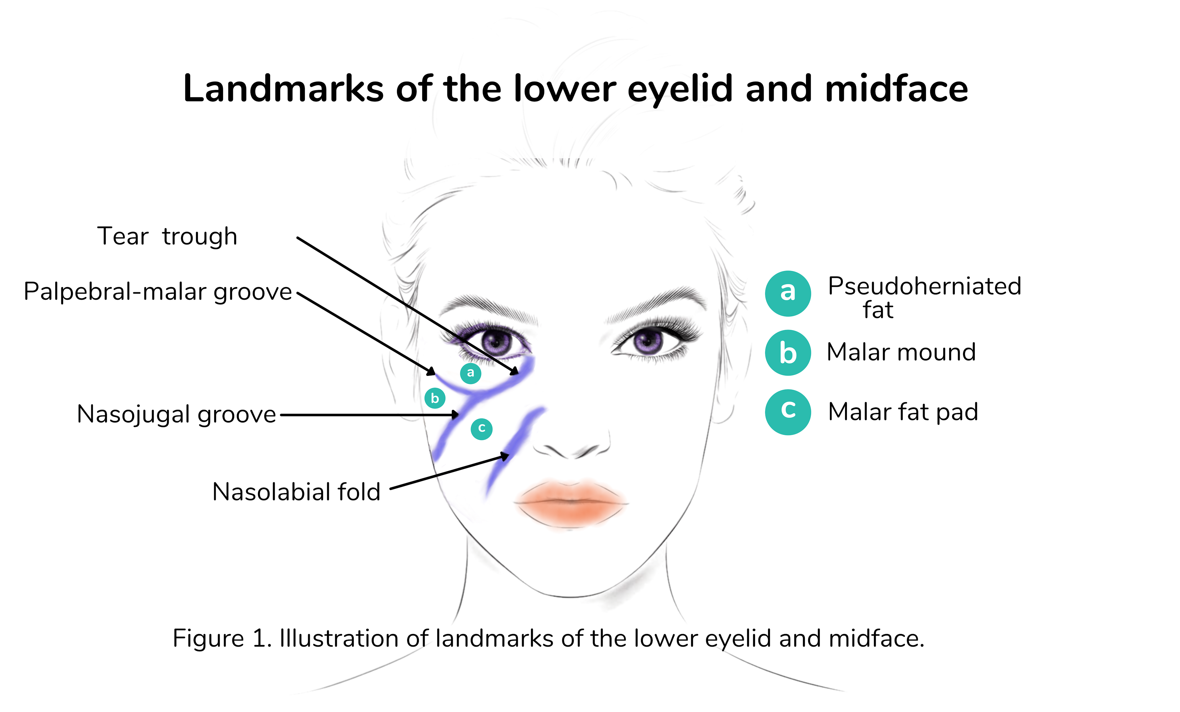 Lower eyelid and midface landmarks