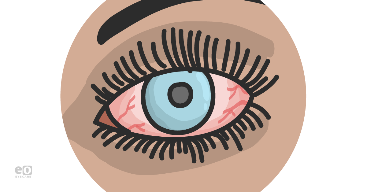 The Optometrist's Guide to Red Eye