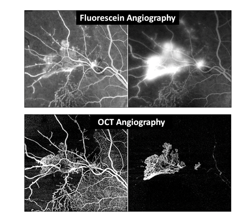 Fluorescein vs OCT Angiography Fig-1