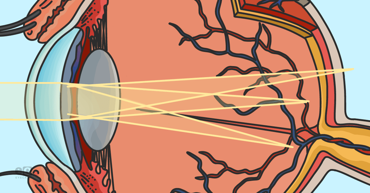 Closeup of an anatomical drawing of an eye showing with-the-rule, against-the-rule, and oblique astigmatism.