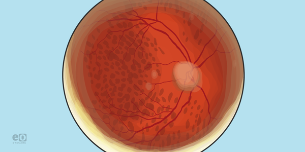 Case Report: Non-Arteritic Anterior Ischemic Optic Neuropathy