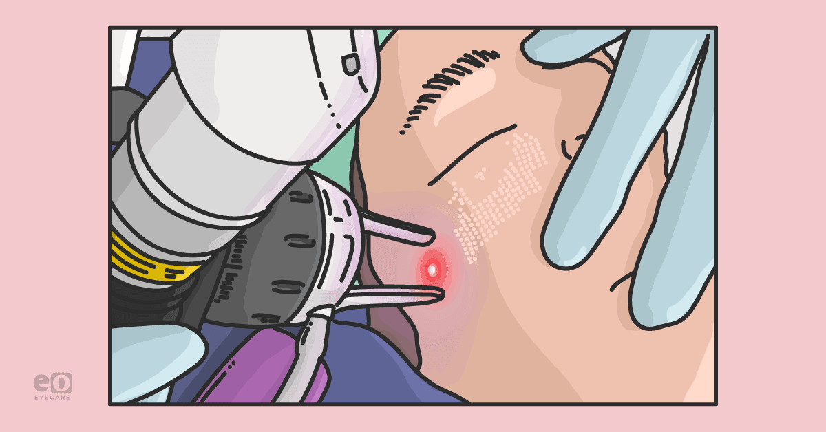 Illustration of a patient undergoing a carbon dioxide (CO2) laser resurfacing procedure, which can be done in conjunction with blepharoplasty.