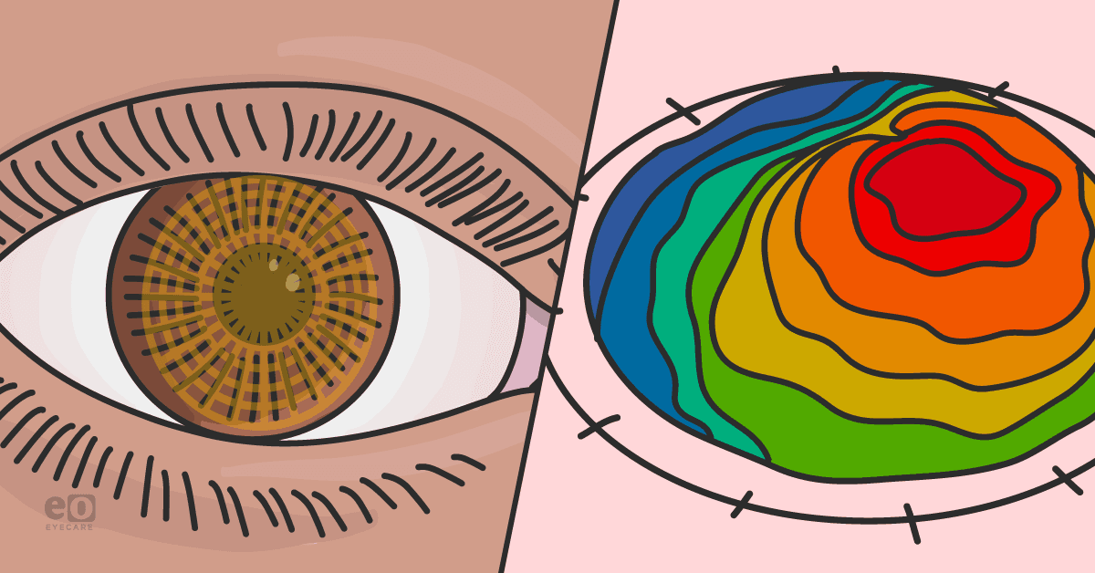 Closeup of an eye being assessed with biometry and corneal topography to successfully implant a toric intraocular lens (IOL).