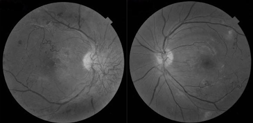 Black and white fundus photograph