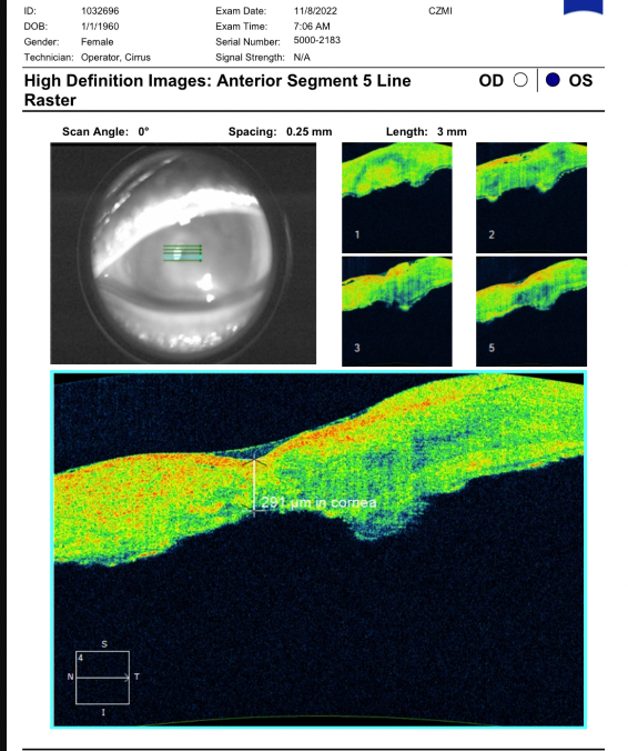 Anterior Segment with corneal thickness measuring 291 μm at thinnest location with Zeiss Cirrus 5000 