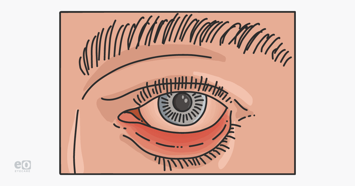 Illustration of an eye with ectropion, a condition ophthalmologists can treat, resulting in lower eyelid laxity.