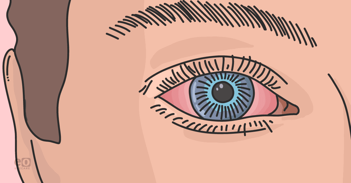 Closeup of a patient's eye, which is red around the iris, as a result of ocular syphilis.