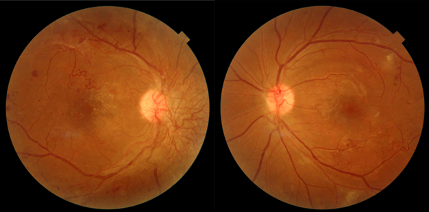 Diabetic retinopathy color fundus