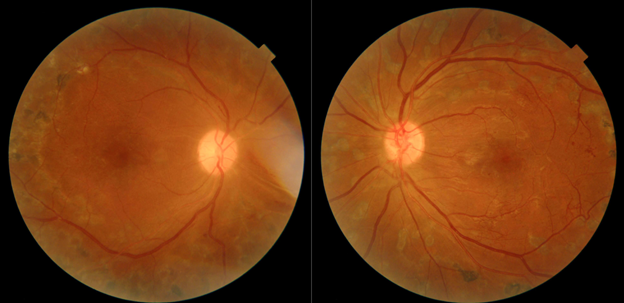 Color fundus photograph at follow-up post-PRP