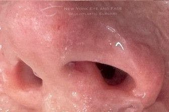 Image of a patient's nose with facial vessels after undergoing BBL therapy.