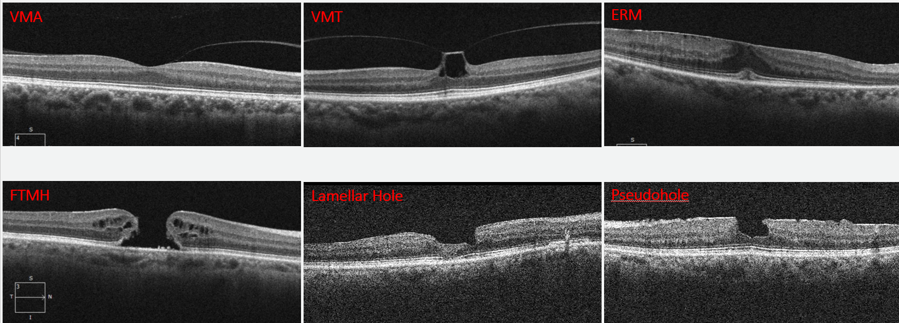 OCT imaging can identify specific characteristics of vitreomacular interface disorders that are crucial to differential diagnosis