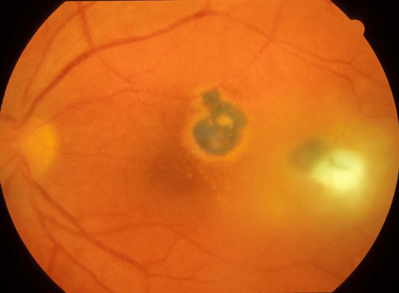 Figure 6: Classical presentation of posterior uveitis secondary to Toxoplasmosis with a focal area of retinitis proximal to a chronic pigmented scar.
