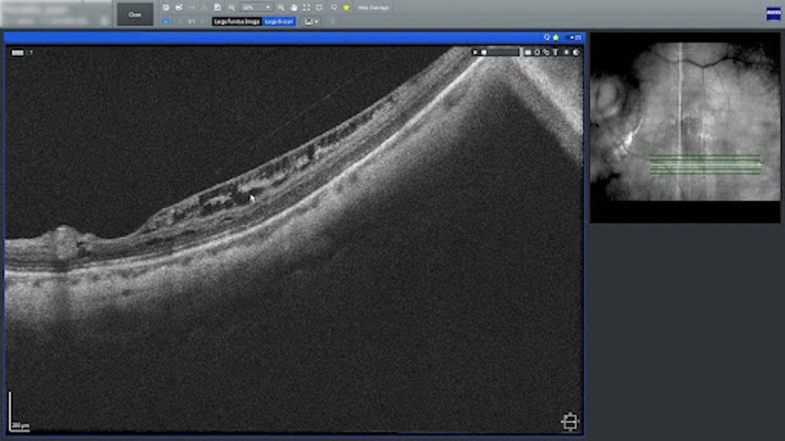 Myopic macular schisis can only be seen with OCTA