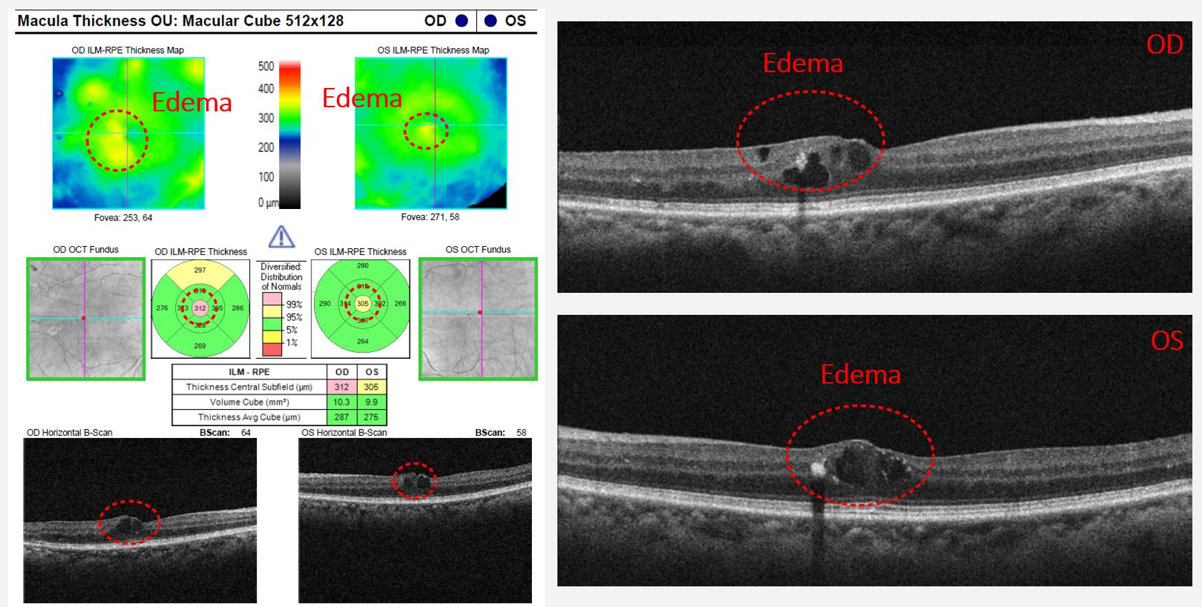 Areas of irregular edema are circled on the thickness map the quantitative map and the B-scan.  Note that the location of the edema is correlated in each component of the report