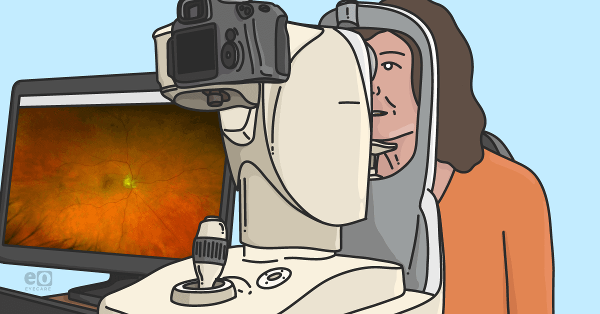 Image of a patient with chorioretinal folds being imaged with color fundus photography.