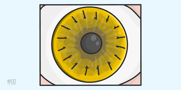 What ODs Should Know About Corneal Transplants
