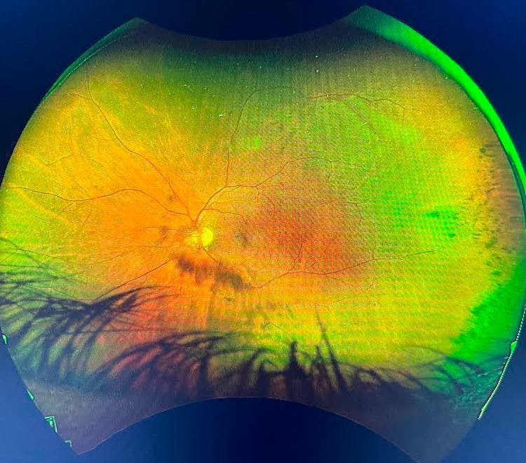 Severe non-proliferative diabetic retinopathy Fundus OS