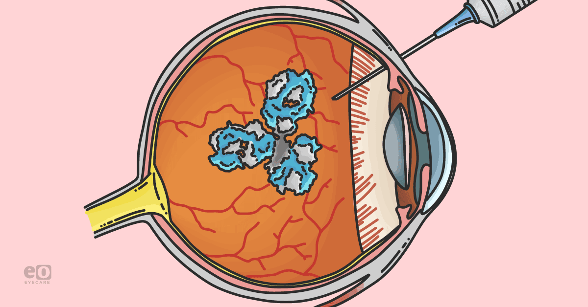 Image of a biosimilar intravitreal injection being administered to an eye with retinal disease.