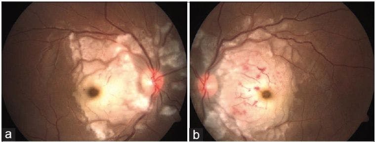 Fundus pregnant woman with Purtscher-like retinopathy